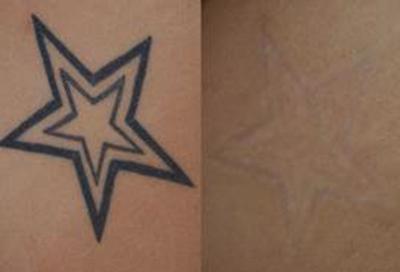 Tattoo Removal